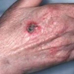 Skin Cancer
