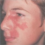 Vascular Nevus