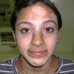Laser for Vitiligo
