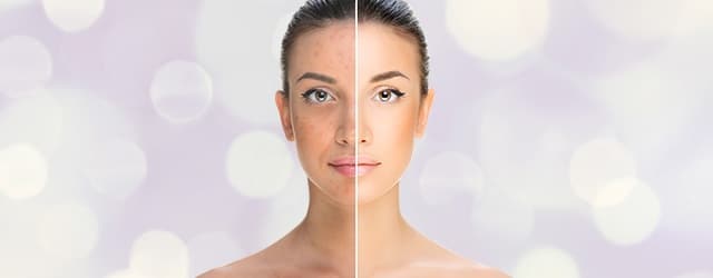 Skin Rejuvination